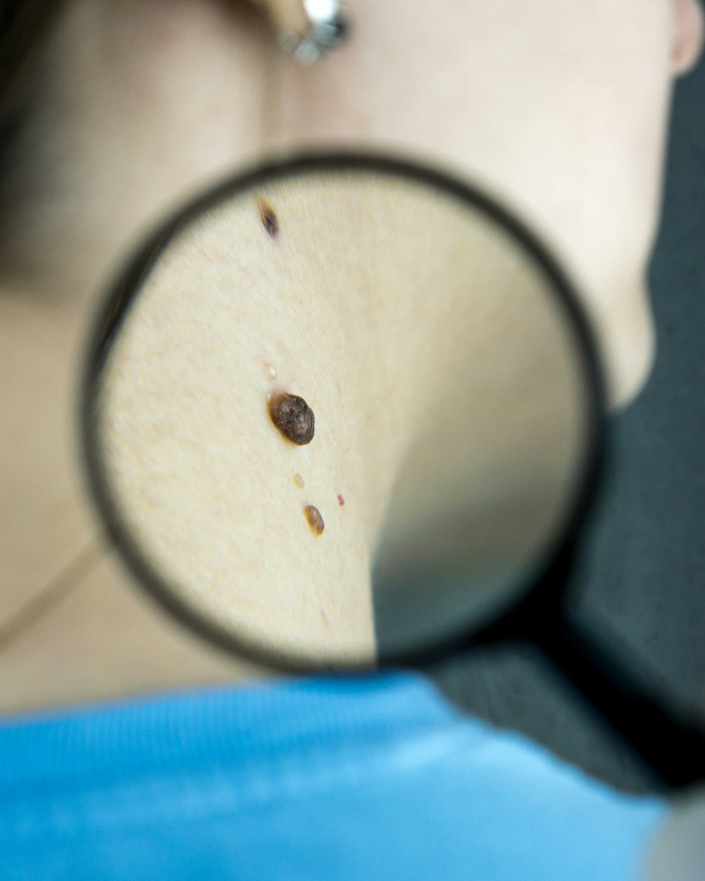 Mole & Lesion Check
