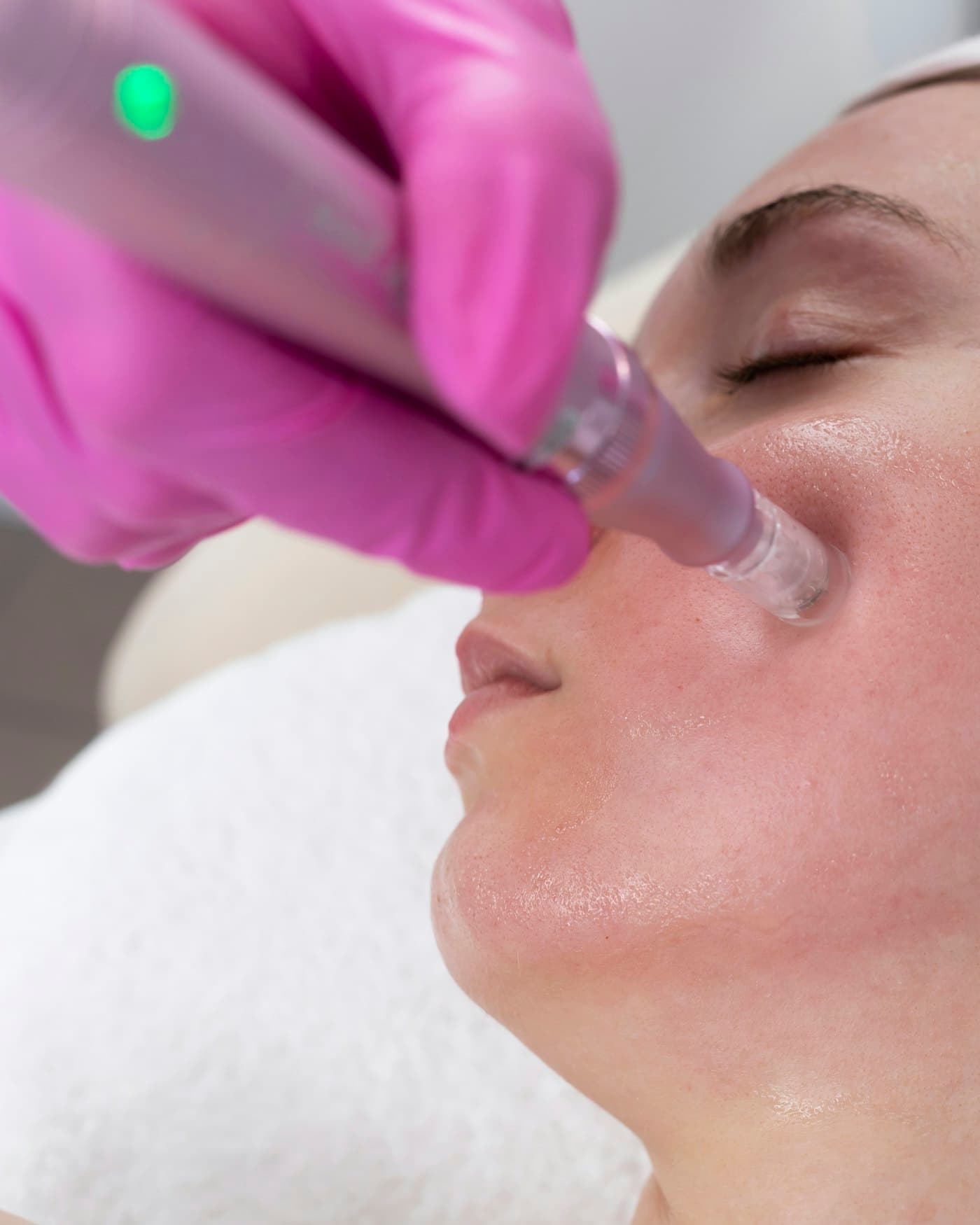 Dermapen Microneedling