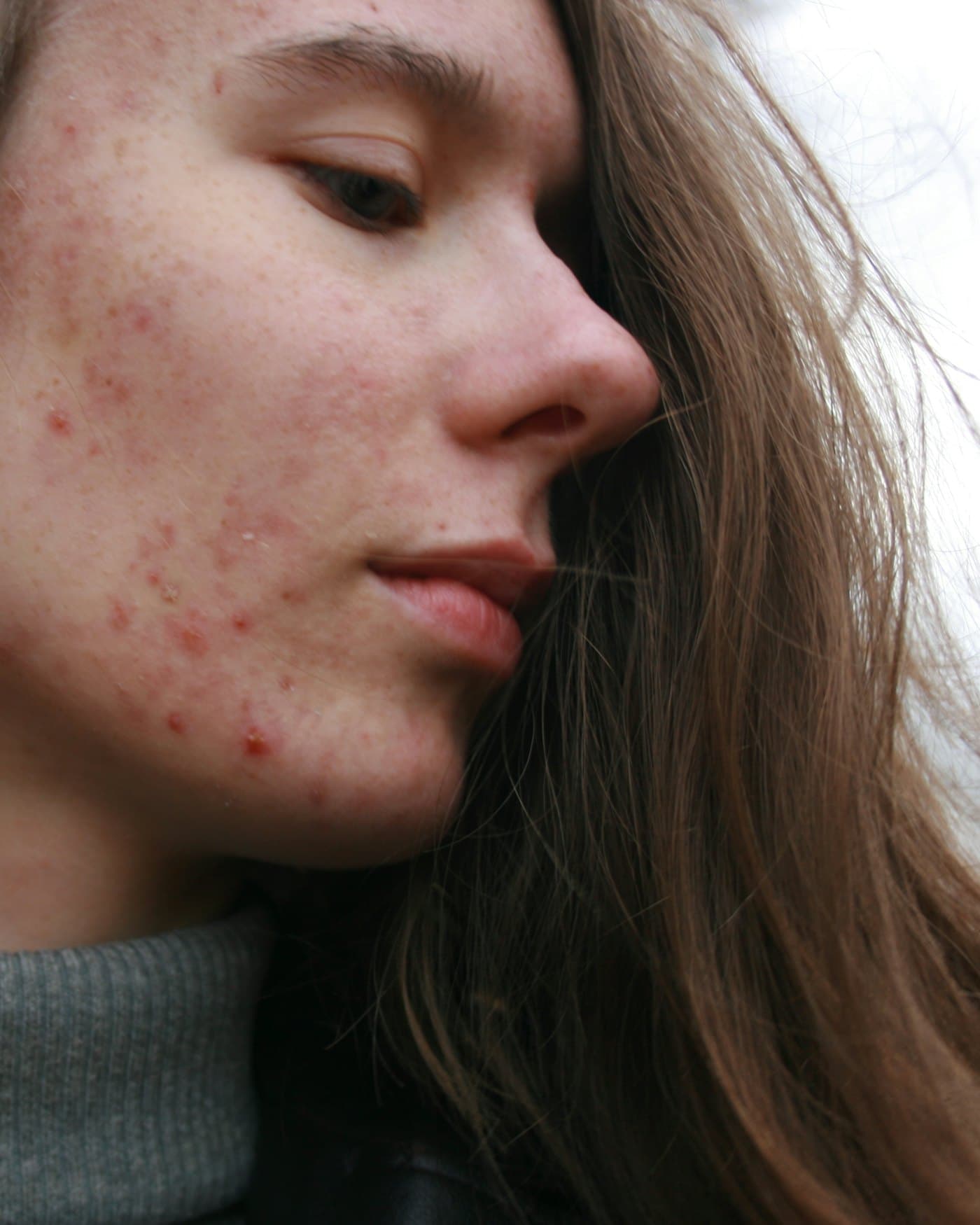 Deep Chemical Peel