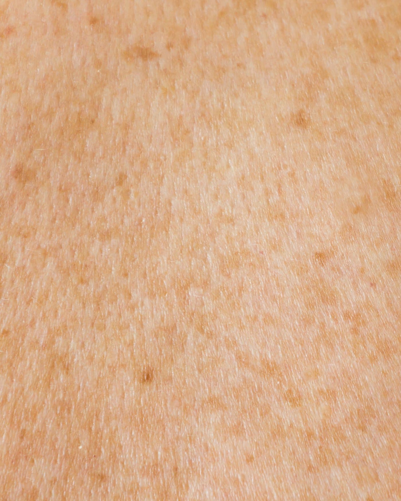 Pigmentation Laser
