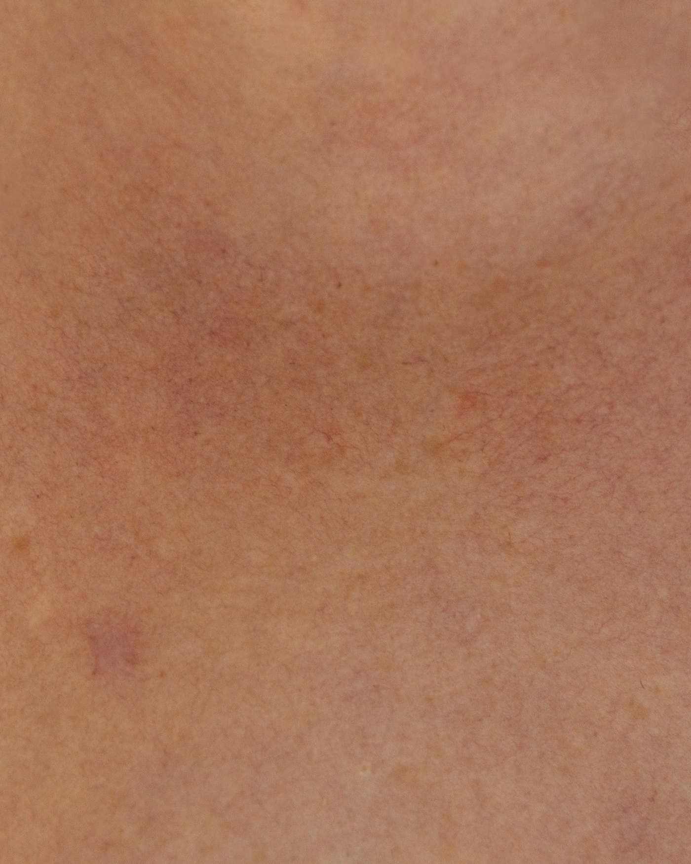 Vascular Laser